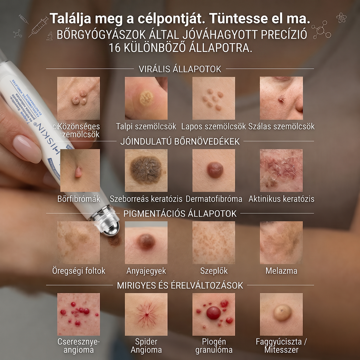 🎁🎁🎁HISKIN® Már csak 5 doboz maradt! Élvezd a további 30% kedvezményt! Távolítsd el a szemölcsöket, javítsd ki a bőrhibákat, és nyerd vissza a tiszta, sima bőrt! Ne hagyd ki ezt a lehetőséget, ez az ajánlat jövőre már nem érvényes.